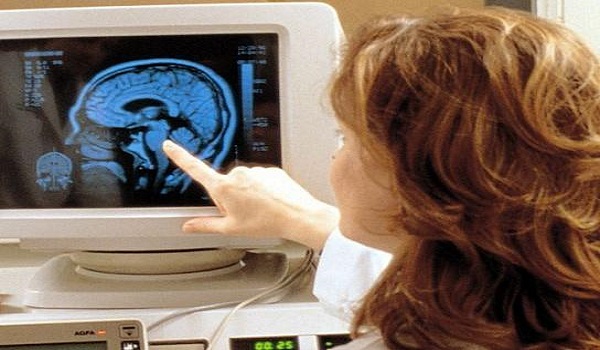 Το Νο1 πρώιμο σύμπτωμα του καρκίνου του εγκεφάλου που οι περισσότεροι αγνοούν, σύμφωνα με νευρολόγο και ογκολόγο