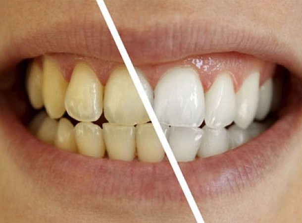 Πώς να έχετε λευκότερα δόντια χωρίς οδοντόβουρτσα