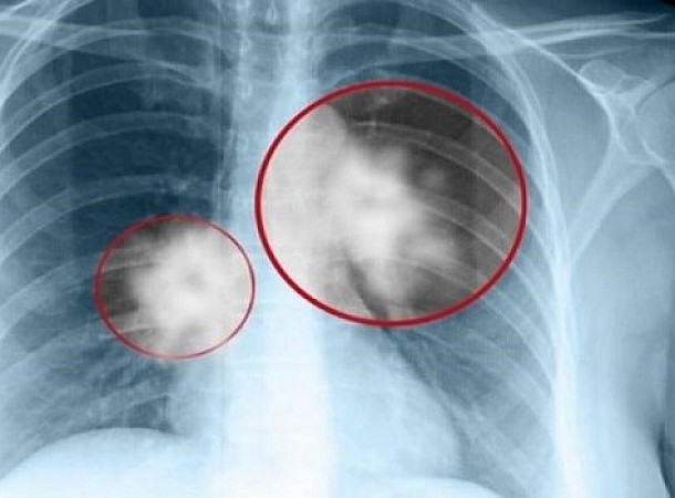 Καρκίνος του πνεύμονα: Η καθοριστική κίνηση που σώζει ζωές