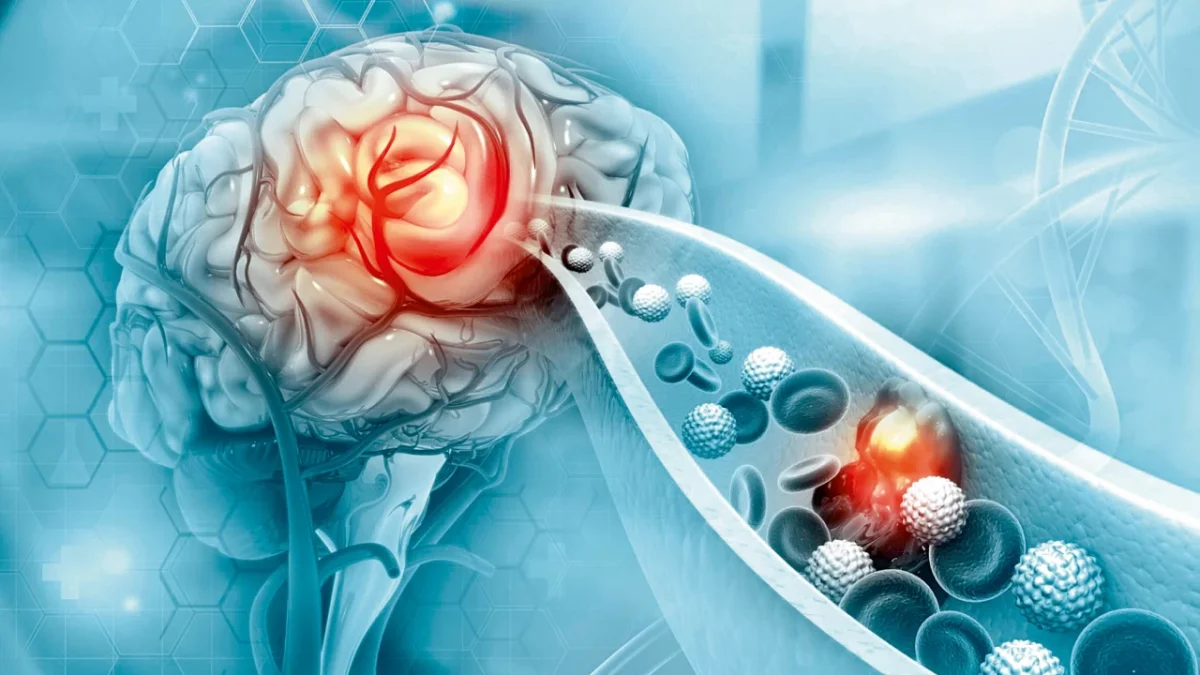 Τρόποι για να μειώσεις τον κίνδυνο εγκεφαλικού επεισοδίου: Προληπτικά μέτρα