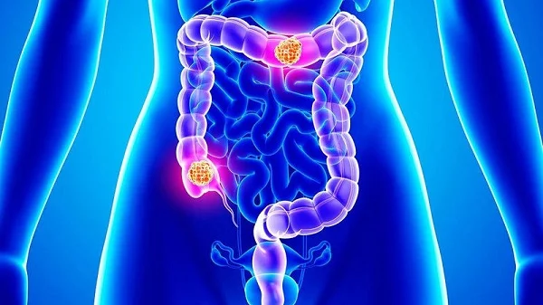 Διαγνώστηκε με καρκίνο στα 33 της μοιράζεται τα 2 συμπτώματα που αγνόησε