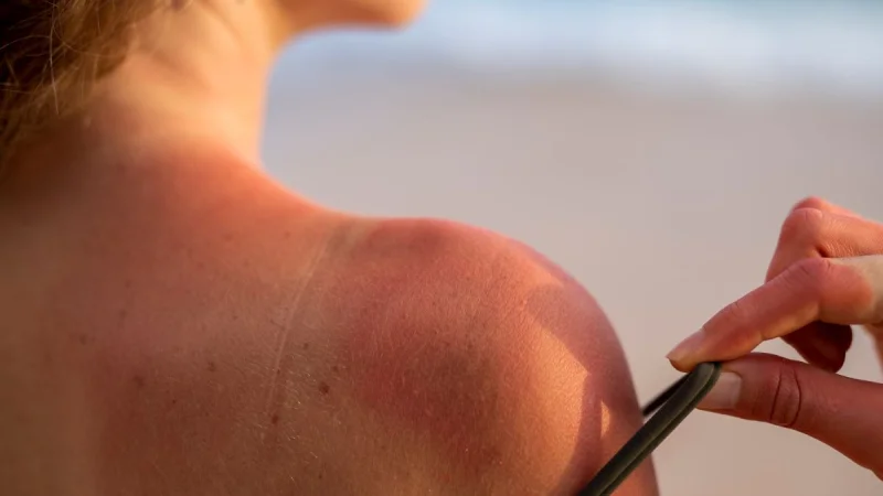 Τρεις τρόποι για να ανακουφιστείς γρήγορα από το ηλιακό έγκαυμα